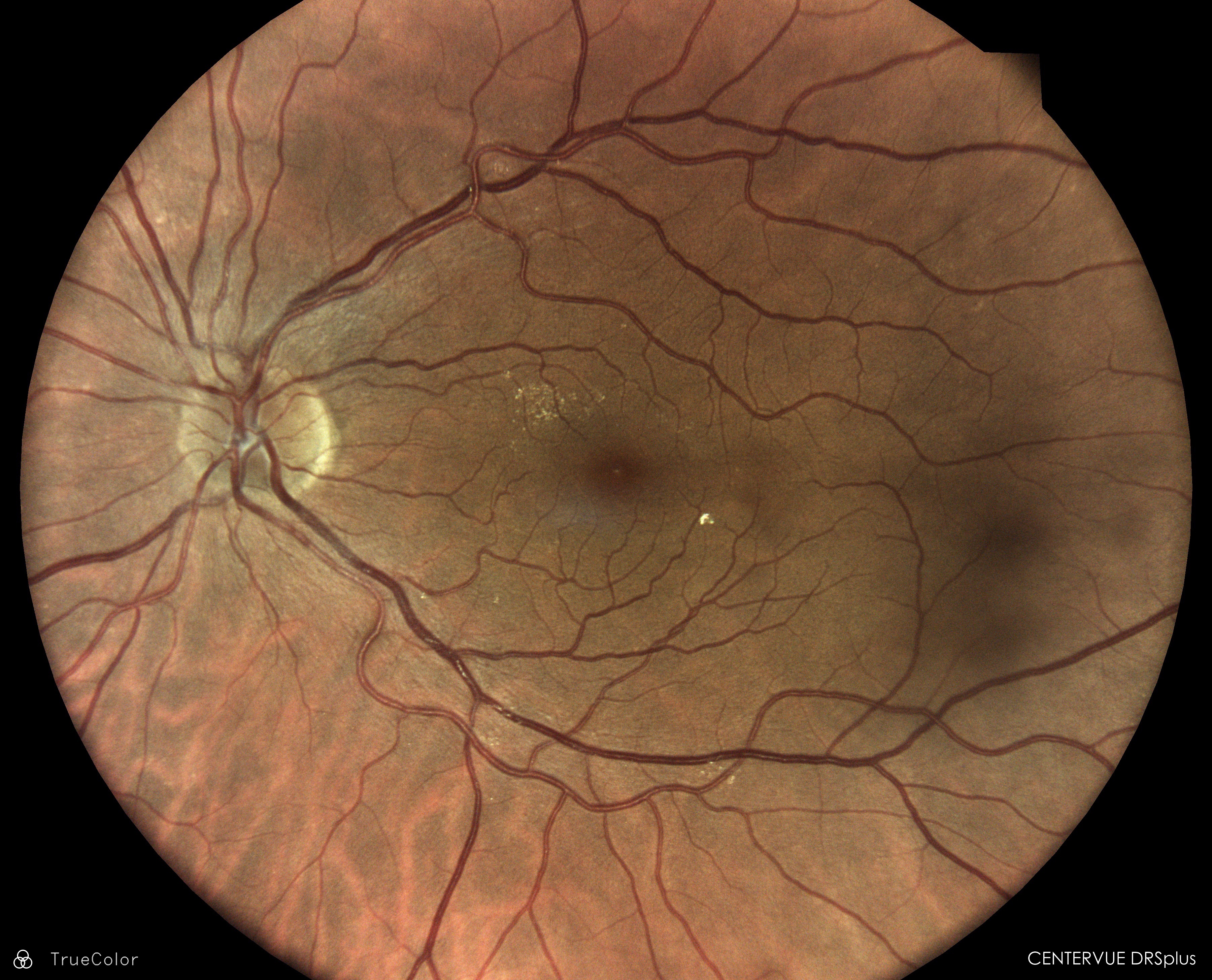 A retinal photograph showing the optic disc and branching blood vessels